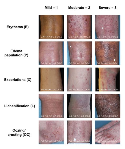 Examples Of The Five Signs Assessed In A Target Lesion Representative Download Scientific