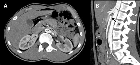 Nutcracker Syndrome How To Diagnose It And When How Should It Be