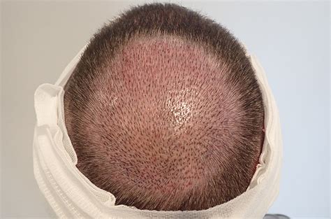 Haartransplantation Vorher Nachher Dr Stiefsohn