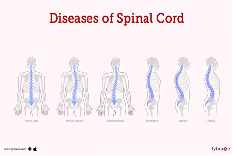 Spinal Cord (Human Anatomy): Picture, Functions, Diseases, and Treatments