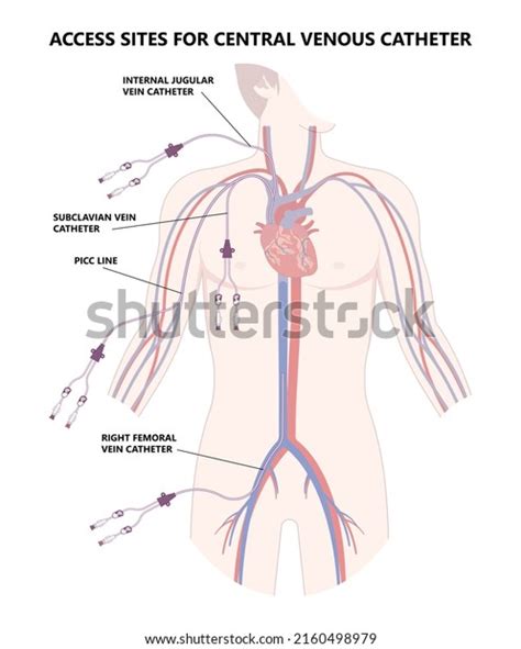 1,818 Tunneled Central Line Images, Stock Photos & Vectors | Shutterstock