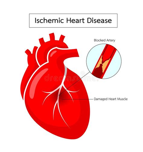 Ischemic Heart Disease Infographics. Signs, Symptoms, And Treatment ...