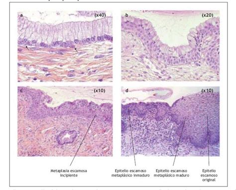 Figure From Lesiones Intraepiteliales Escamosas De C Rvix De Bajo