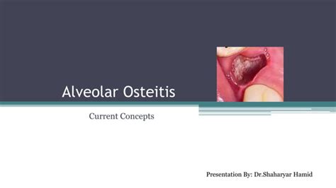 Alveolar Osteitis Dikiohs Duhs Ppt