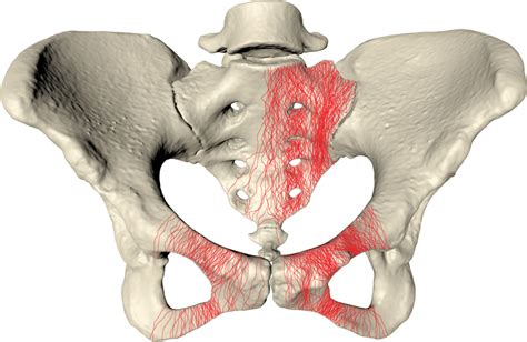 Morphological Mapping Of The Fracture Lines In Lc 1 Pelvic Fracture Download Scientific