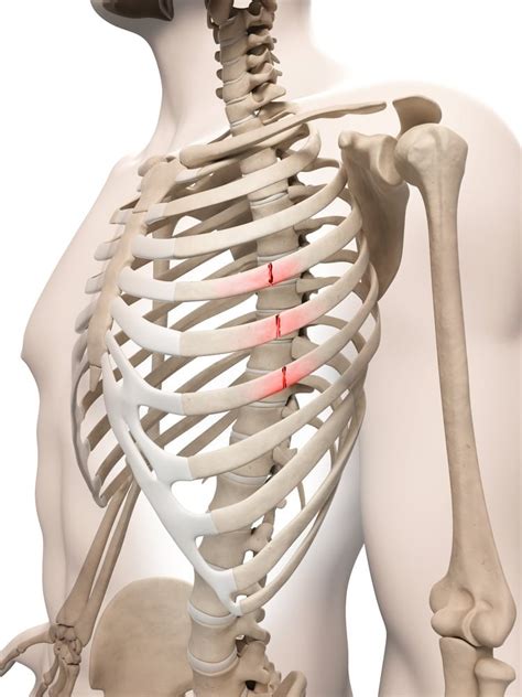 Rib Bone Fracture Healing Time at johnmmccrary blog