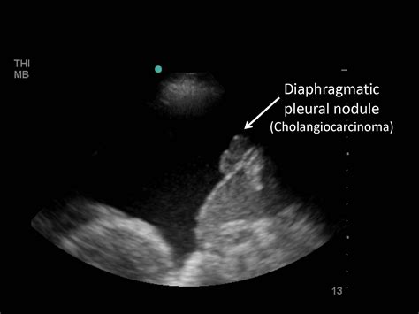 Thoracentesis Pleural Biopsy And Thoracic Ultrasound Pulmonology Advisor