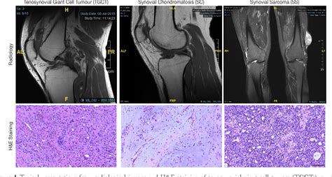 Figure 1 From Clinical Comparison Of Tenosynovial Giant Cell Tumors