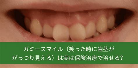 ガミースマイル（笑った時に歯茎ががっつり見える）は実は保険治療で治せる？ 長崎の矯正専門「すずき矯正歯科」