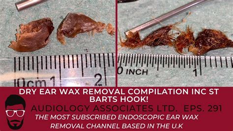 Ear Wax Removal Compilation Inc St Barts Hook Ep291 Youtube