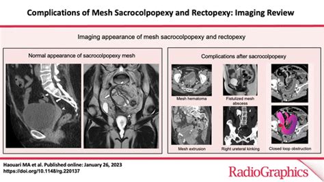 Complications Of Mesh Sacrocolpopexy And Rectopexy Imaging Review