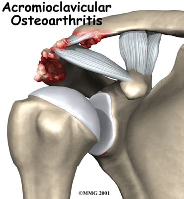 AC Joint Arthritis Causes, Symptoms & Treatment | Dr Kaushik