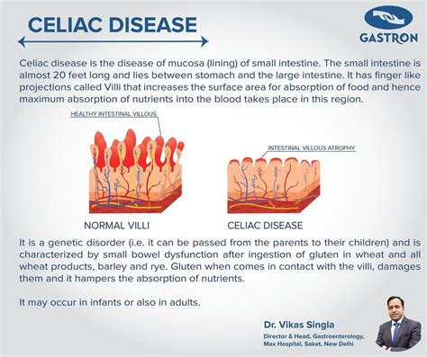 Celiac Disease Symptoms And Treatment Dr Vikas Singla