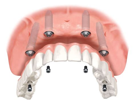 All On 4 Dental Implants