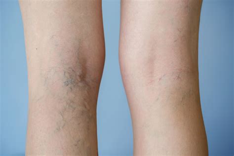 How Can You Get Rid Of Varicose Veins On Your Legs