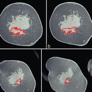 Year Old Woman Diagnosed With Invasive Ductal Carcinoma At O Clock