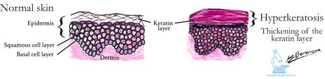 What does hyperkeratosis mean? MyPathologyReport.ca