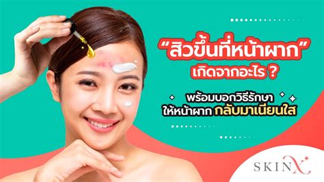 ทำอย่างไรให้สิวหาย วิธีแก้ปัญหาสิวด้วยเคล็ดลับในการดูแลผิวหน้า