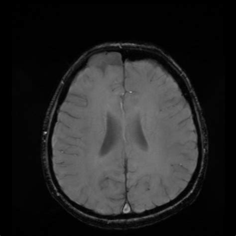 Arachnoid Cyst Image