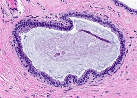 What Is Columnar Cell Change At Carlos Alvarez Blog