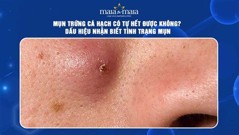 Mụn Trứng Cá Hạch Nguyên Nhân Và Cách điều Trị Hiệu Quả