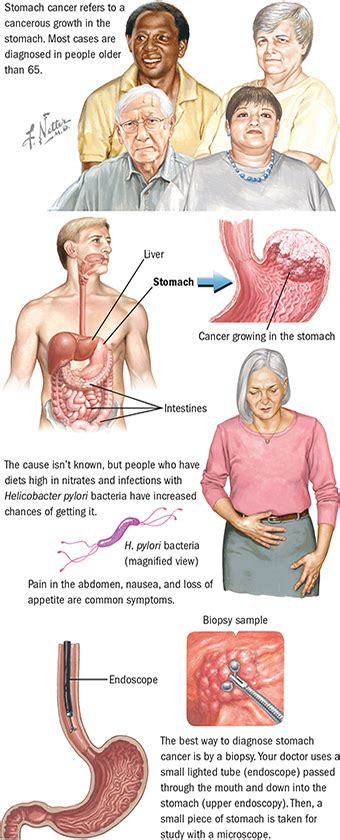 Stomach Cancer Upper Gi Cancers Spectrum Health