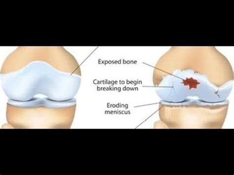 Zwyrodnienie Staw W Przyczyny Objawy I Leczenie Choroby