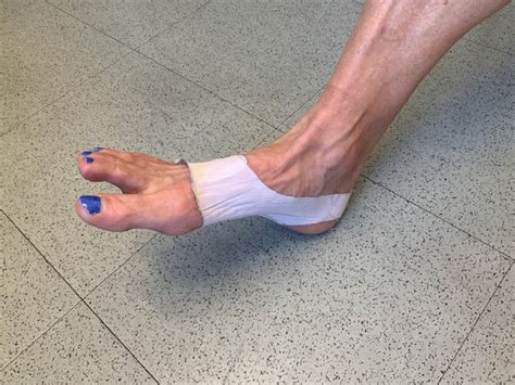 Foot And Ankle Problems By Dr Richard Blake Plantar Fasciitis