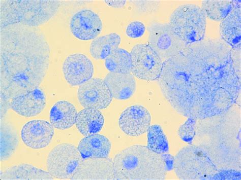 Multivacuolated Foamy Macrophages Stained Blue With Download