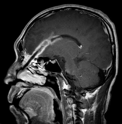 T Gadolinium Enhanced Brain Magnetic Resonance Image With A Sagittal