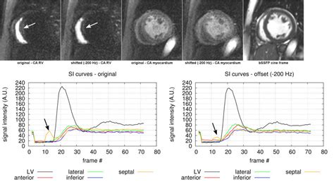 Myocardial First Pass Perfusion Imaging With Hybrid Epi Frequency