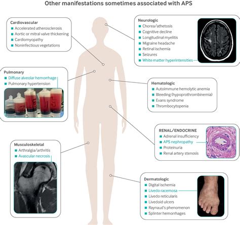 Antiphospholipid Syndrome Advances In Diagnosis Pathogenesis And