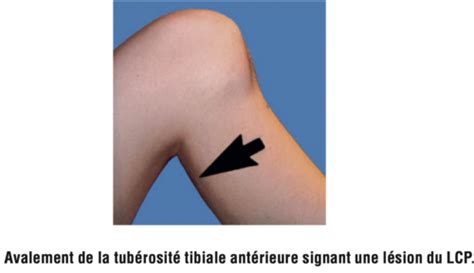 item 361 lésions périarticulaires et ligamentaires du genou lésions