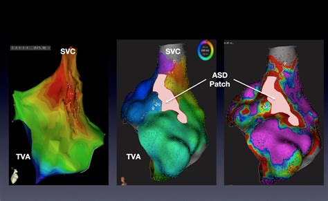 Evaluation Of A Novel High Resolution Mapping Technology For Ablation