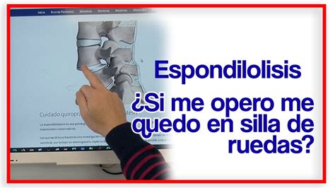 Espondilolistesis L L L S La Importancia De Tratarla Y