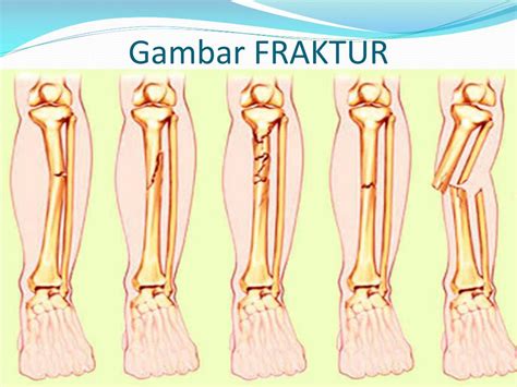 Fractured Arm Bone Broken Arm Symptoms And Causes