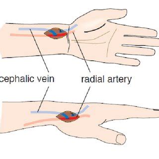 Upper Extremity Fistula Anatomy