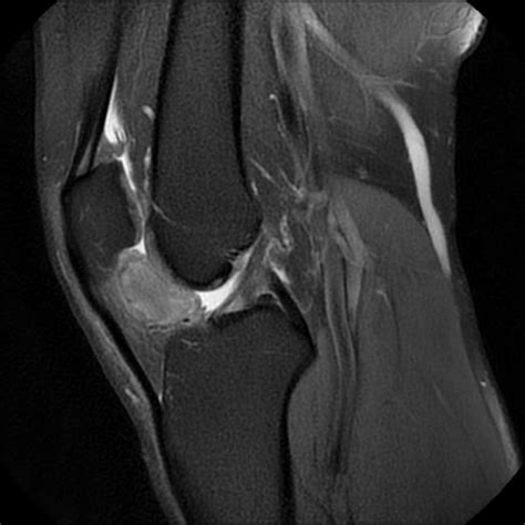 Intracapsular Chondroma Knee Image Radiopaedia Org