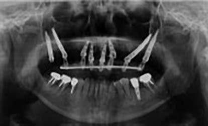 ZYGOMATIC IMPLANTS PLACEMENT CONSIDERATIONS IN IMPLANT SUPPORTED