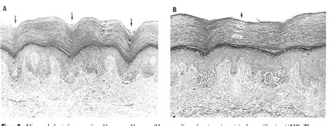 Figure 3 From Distinctive Dermatoscopic Features Of Acral Lentiginous Melanoma In Situ From