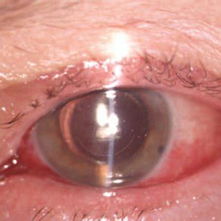 Color Photography Of The Left Eye A First Postoperative Day Slit Lamp