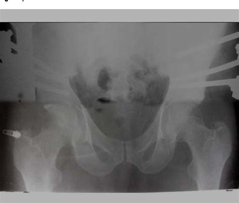 Figure 1 From Treatment Of Open Book Pelvic Fractures Comparison Between Internal And External