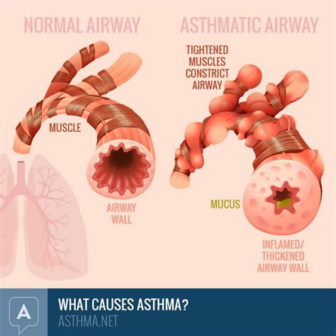 causes of asthma - DriverLayer Search Engine