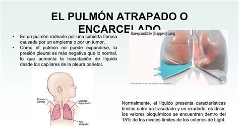 Derrame Pleural Pptx Descarga Gratuita