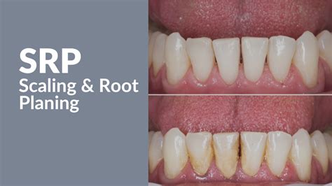 SRP Scaling And Root Planing Successful Billing For Soft Tissue