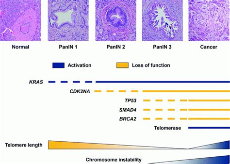 Pathology And Molecular Pathology Of Pancreatic Cancer Oncohema Key