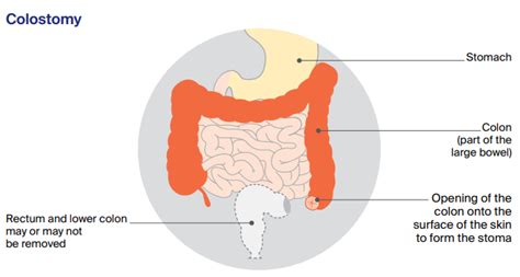 Having A Stoma Cancer Council Victoria