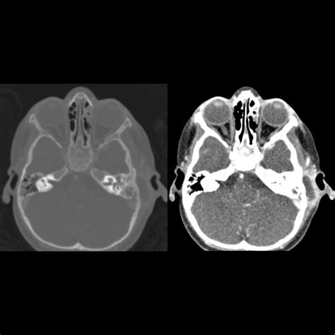 Pediatric Acute Mastoiditis Pediatric Radiology Reference Article