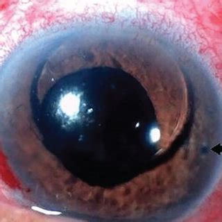 A Anterior Segment Photograph Of The Left Eye Showing Seeping Of