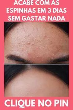 Como Deixar A Pele Sem Acne Como ACABAR Espinhas Em 1 Noite